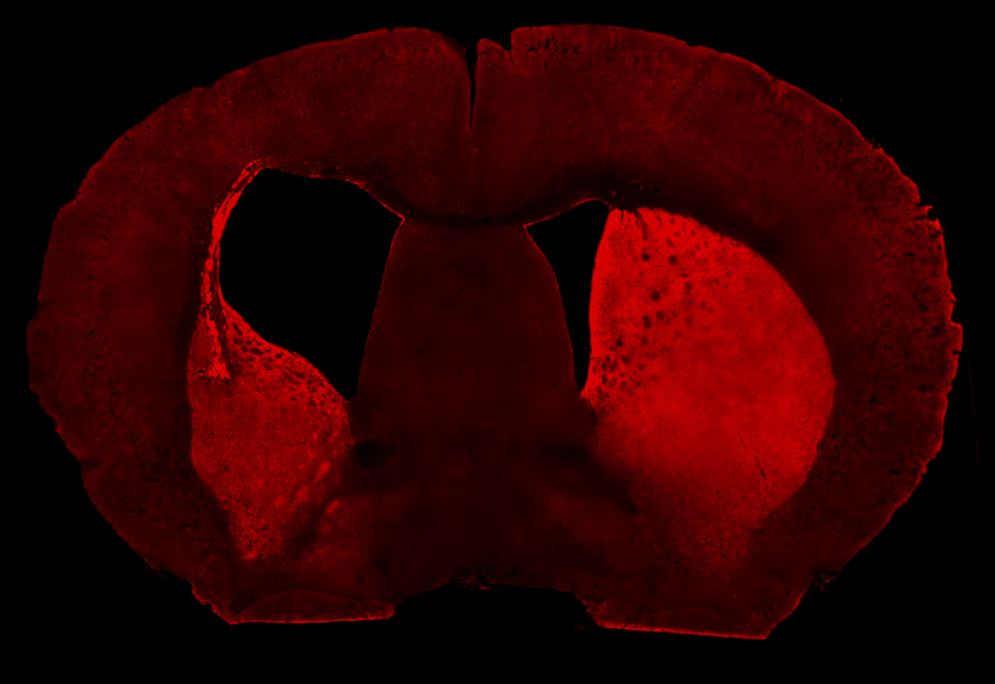 Fluorescence image of a mouse brain five months post transplantation of human cells with HD into the left hemisphere showing an increase in ventricle size because of striatum degeneration.
